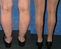 liposuction surgery result