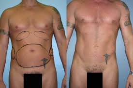 liposuction surgery 9