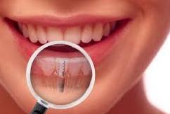 woman with dental implants