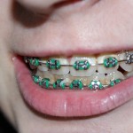 orthodontic treatment