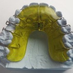 braces