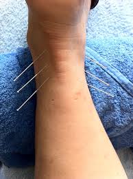 acupuncture needles